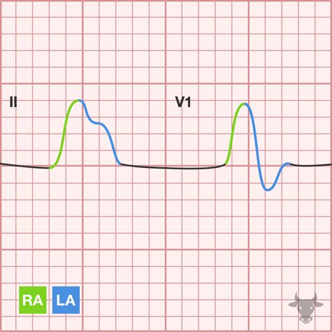 borderline ecg|borderline ecg left atrial enlargement.